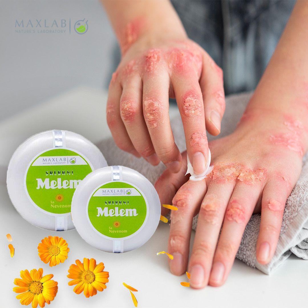 MELEM SREBRNI-SA NEVENOM Ekcemi Psorijaze Posjekotine.. — slika 1 od 3